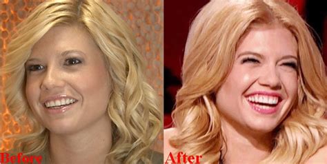 chanel west coast teeth|Chanel West Coast Plastic Surgery Before and After